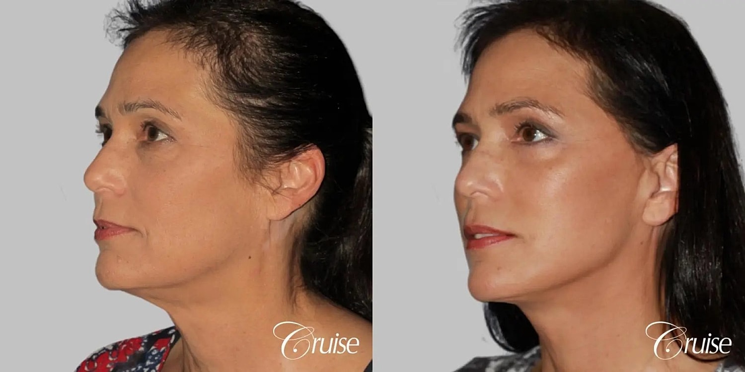 Face Lift Before & After
