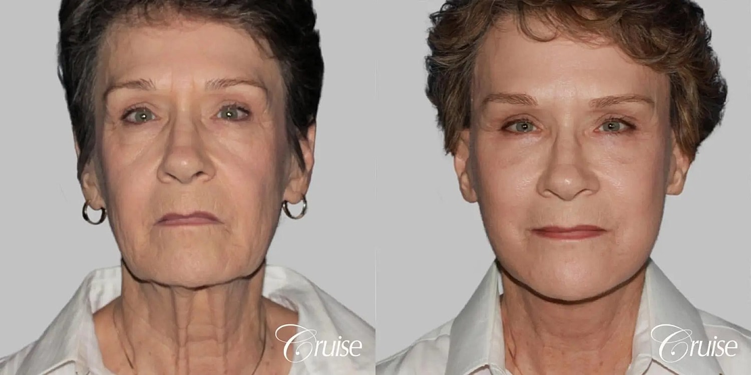 Face Lift Before & After