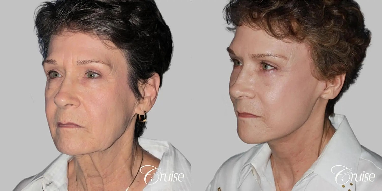 Face Lift Before & After
