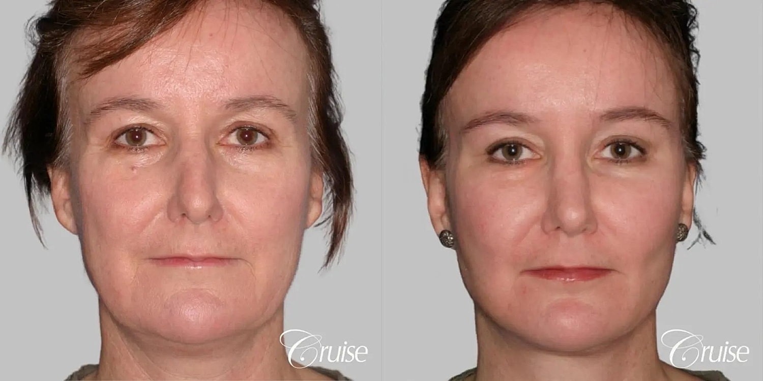 Face Lift Before & After