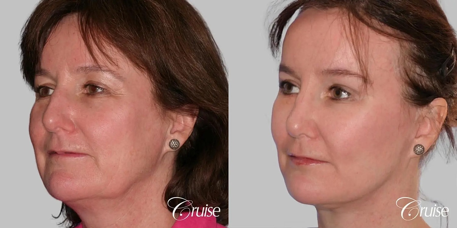 Face Lift Before & After