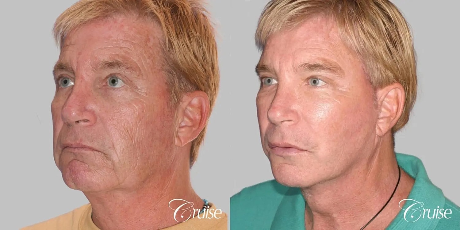 Face Lift Before & After