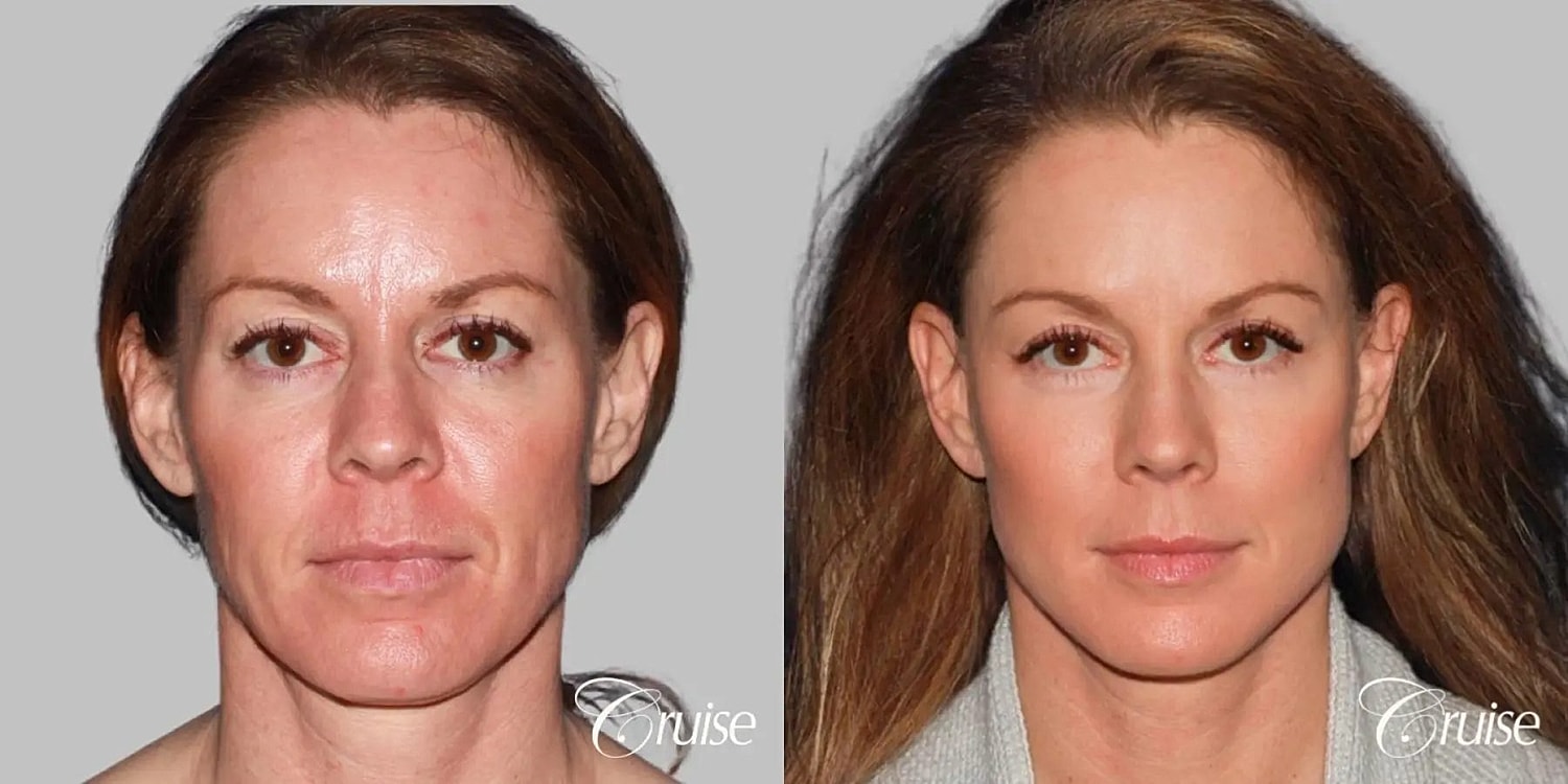 Face Lift Before & After