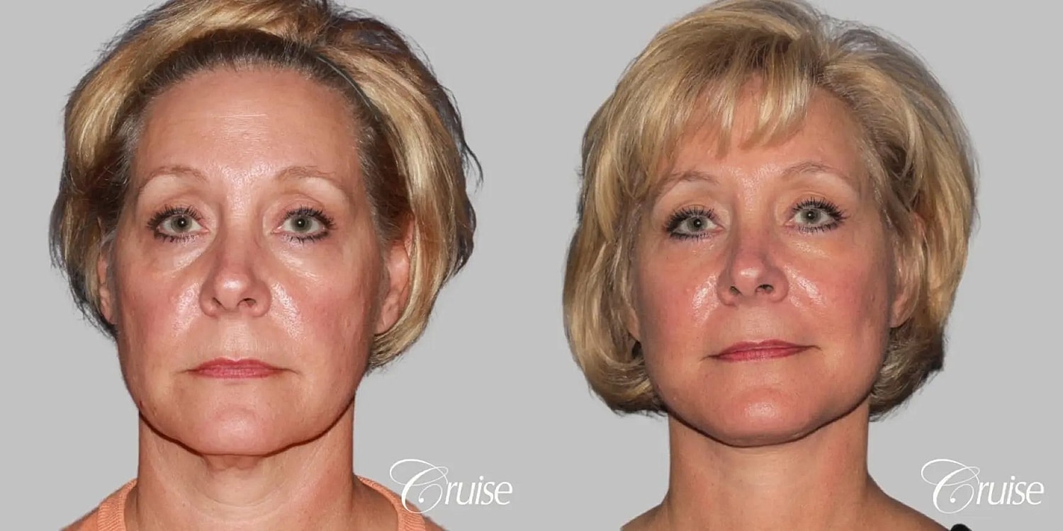 Face Lift Before & After