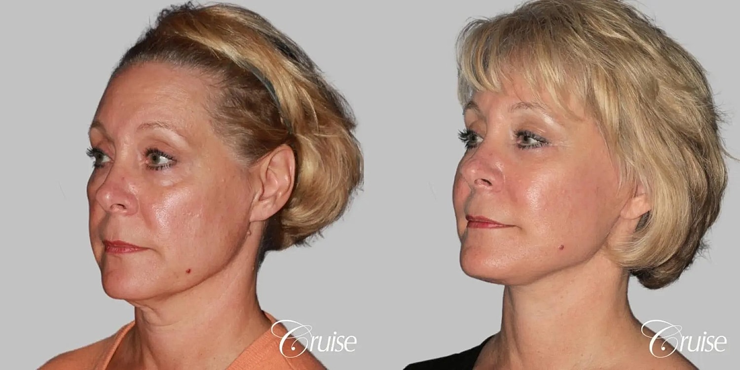 Face Lift Before & After