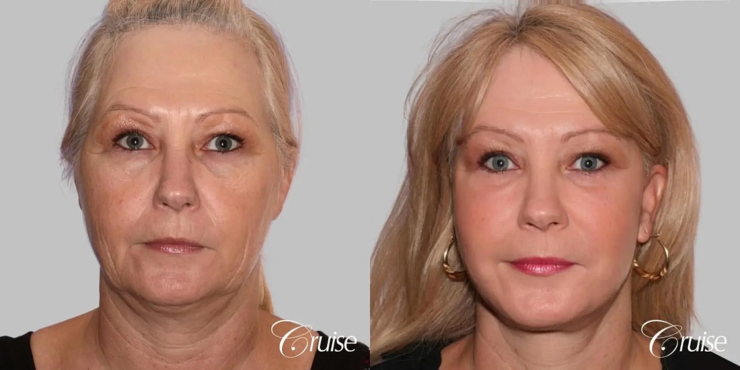Face Lift Before & After