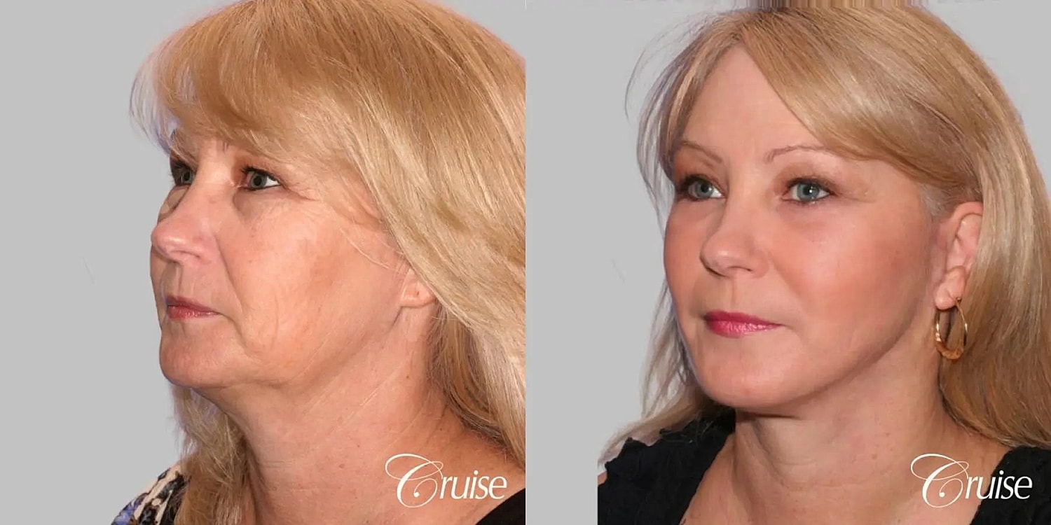 Face Lift Before & After