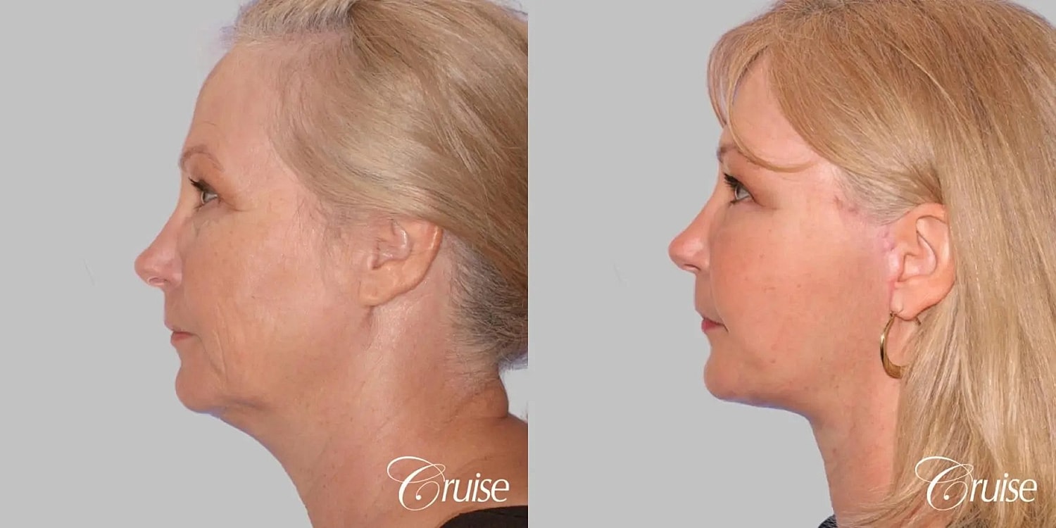 Face Lift Before & After