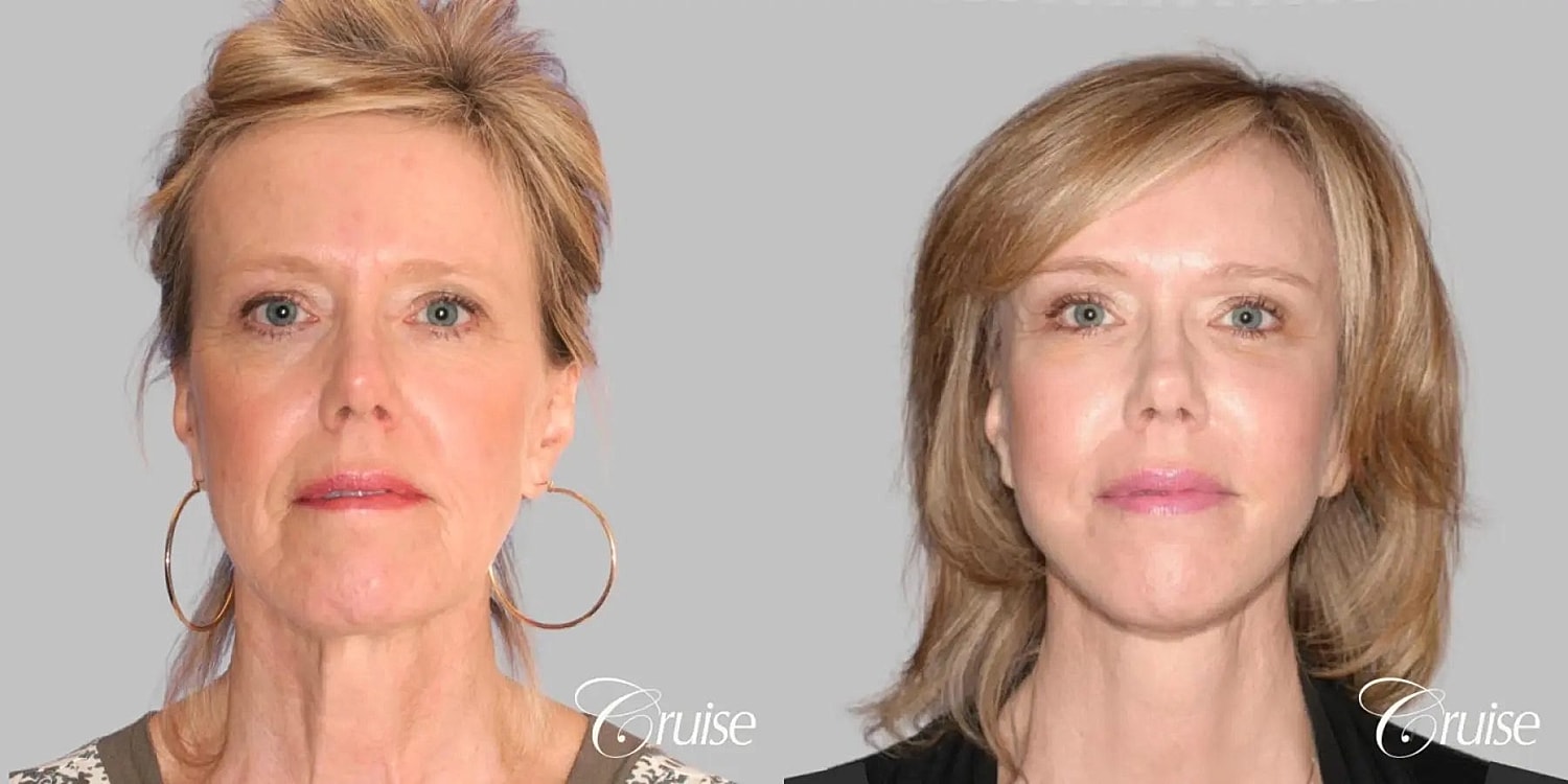 Face Lift Before & After