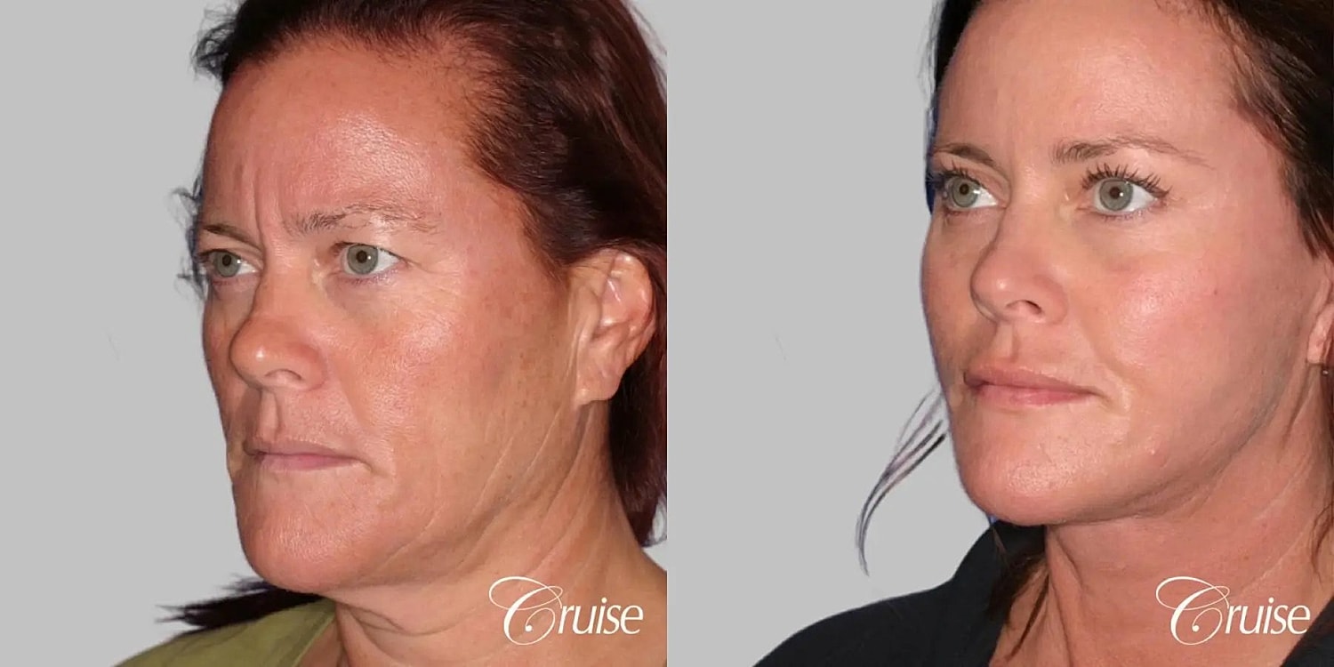 Face Lift Before & After