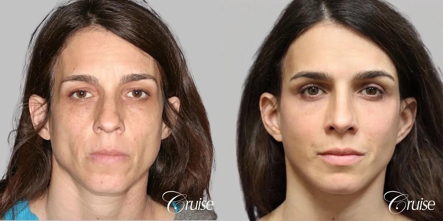 Face Lift Before & After