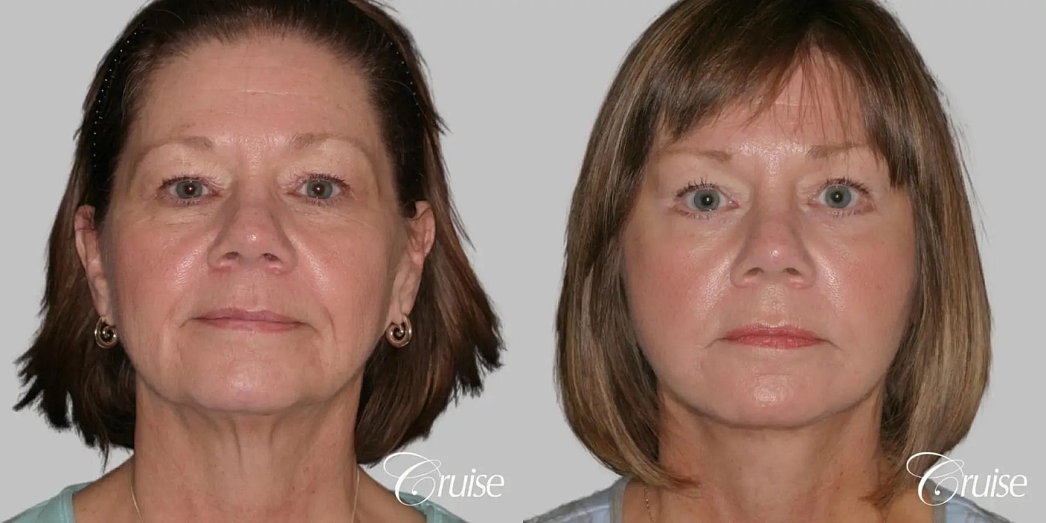 Face Lift Before & After