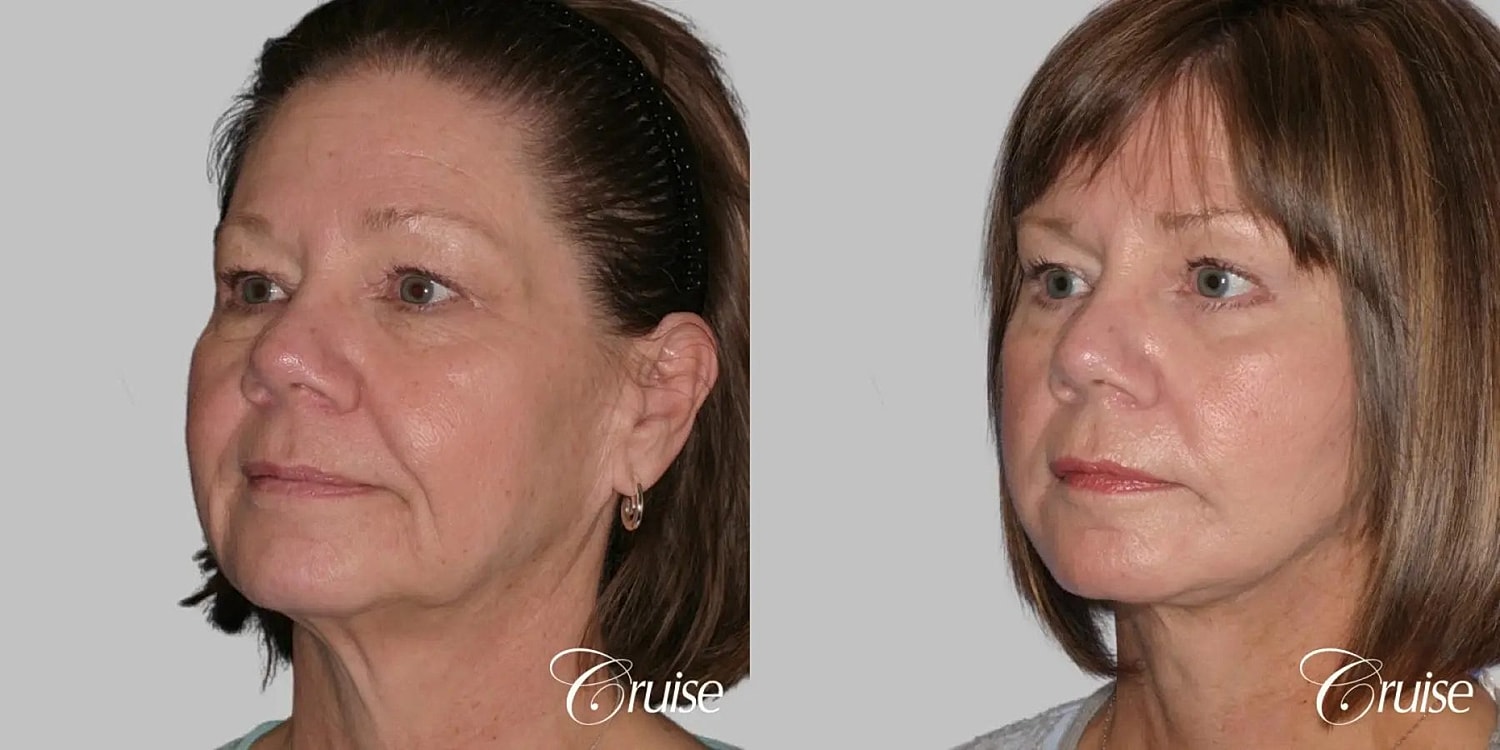 Face Lift Before & After