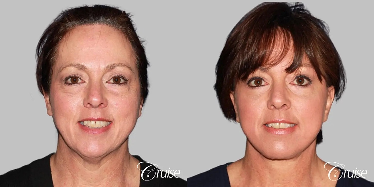 Face Lift Before & After