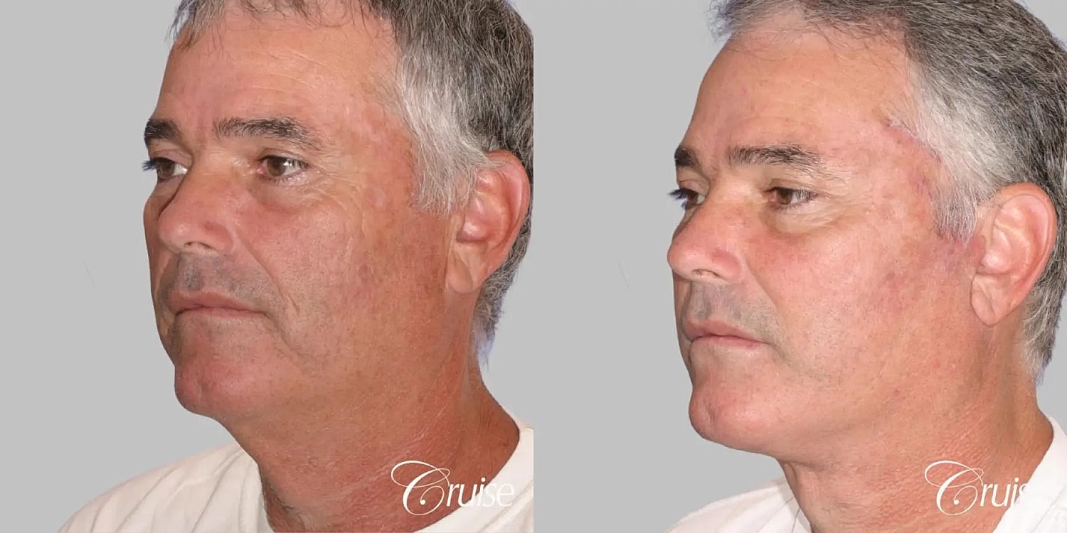 Face Lift Before & After