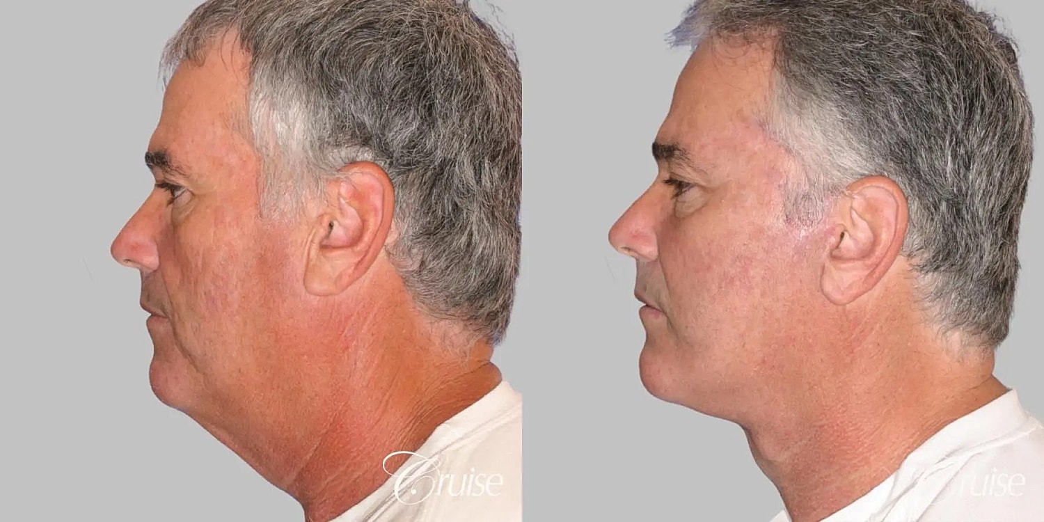 Face Lift Before & After