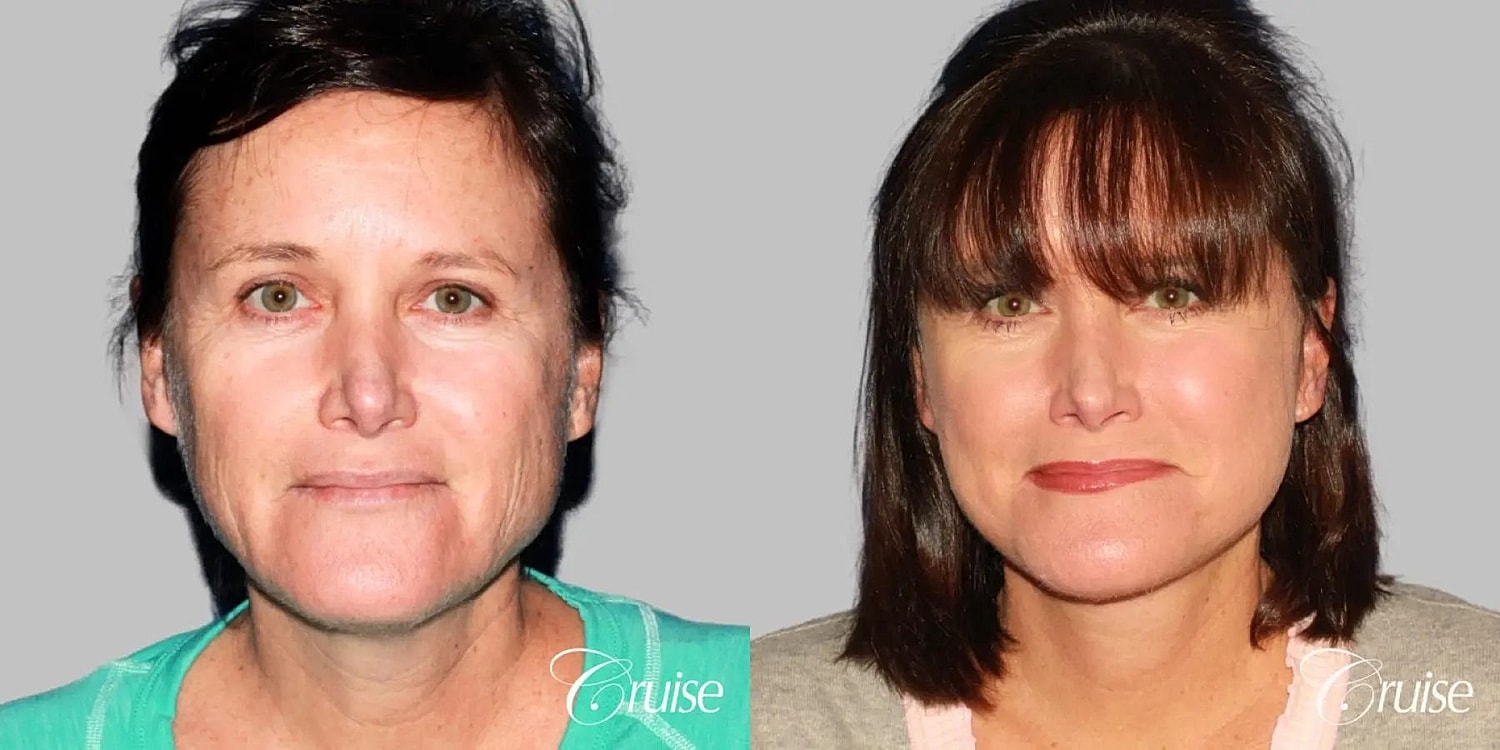 Face Lift Before & After