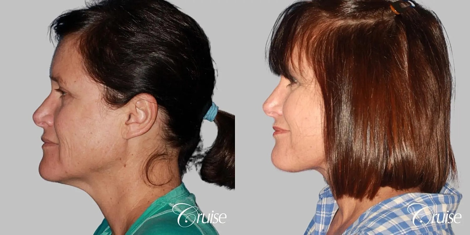 Face Lift Before & After