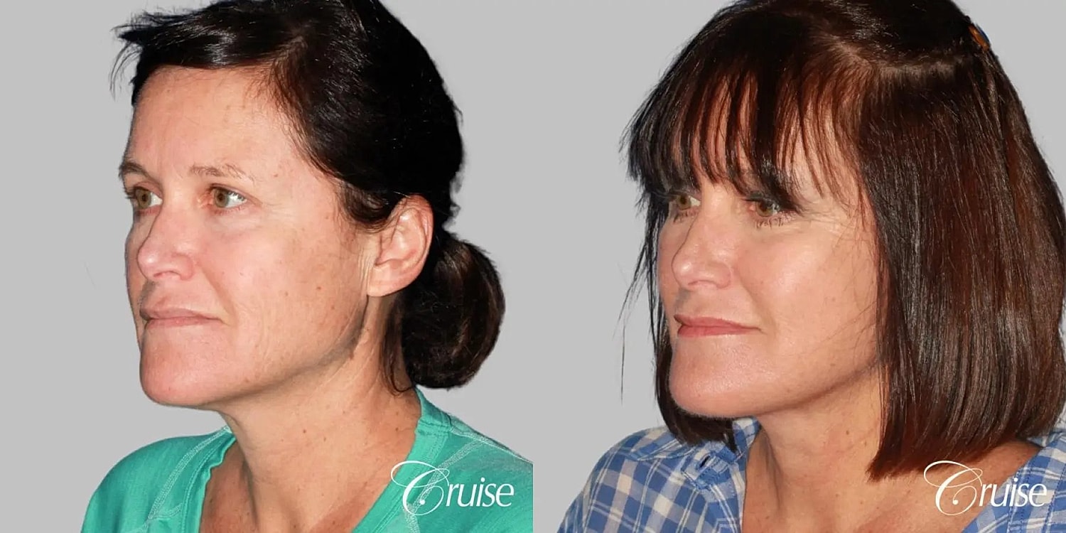 Face Lift Before & After