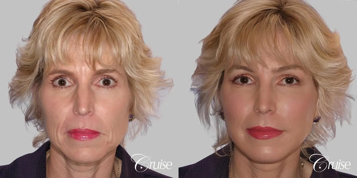 Face Lift Before & After
