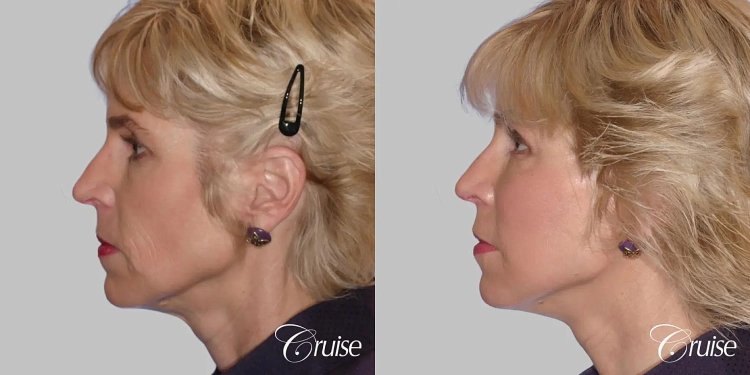 Face Lift Before & After