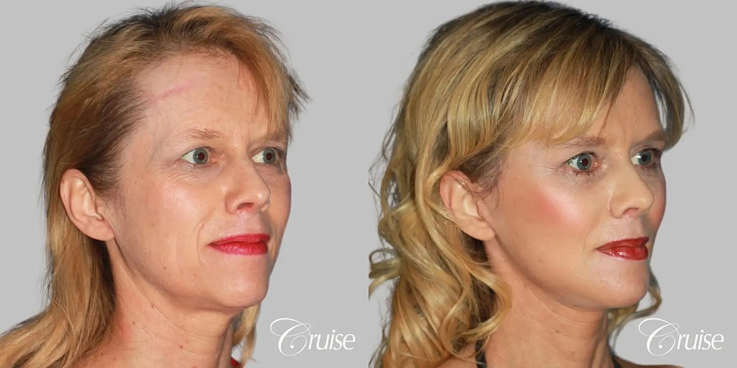 Face Lift Before & After