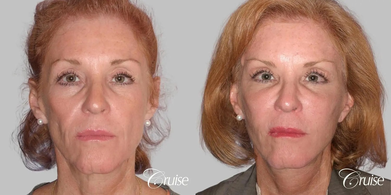 Face Lift Before & After