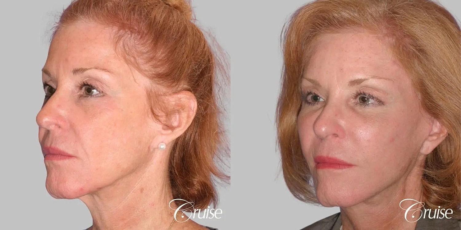 Face Lift Before & After