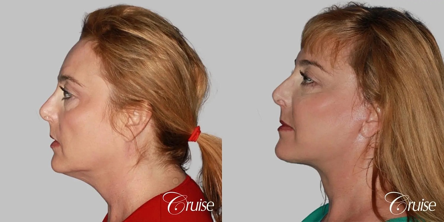 Face Lift Before & After