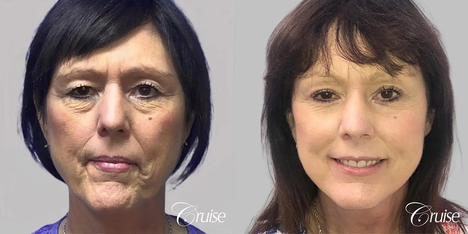 Face Lift Before & After