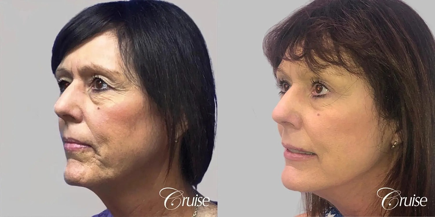 Face Lift Before & After