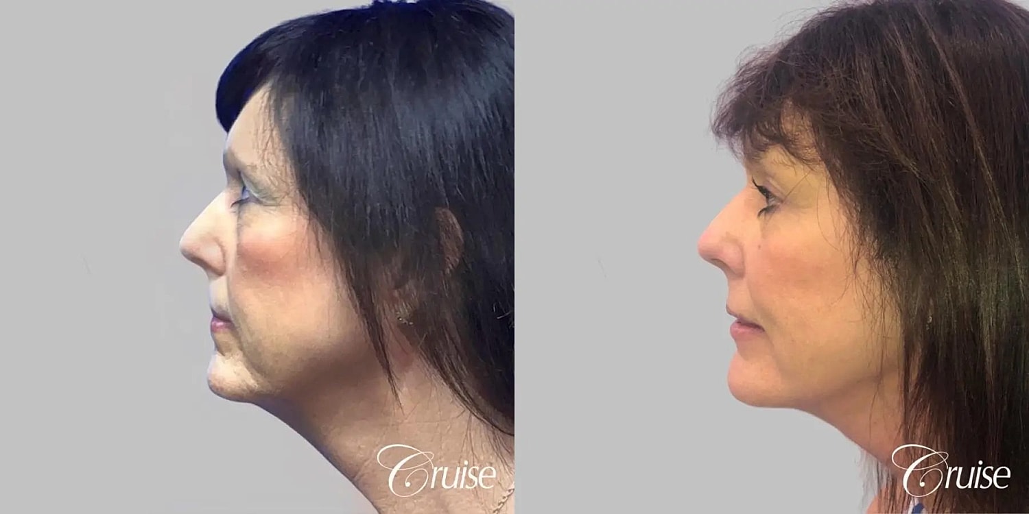 Face Lift Before & After