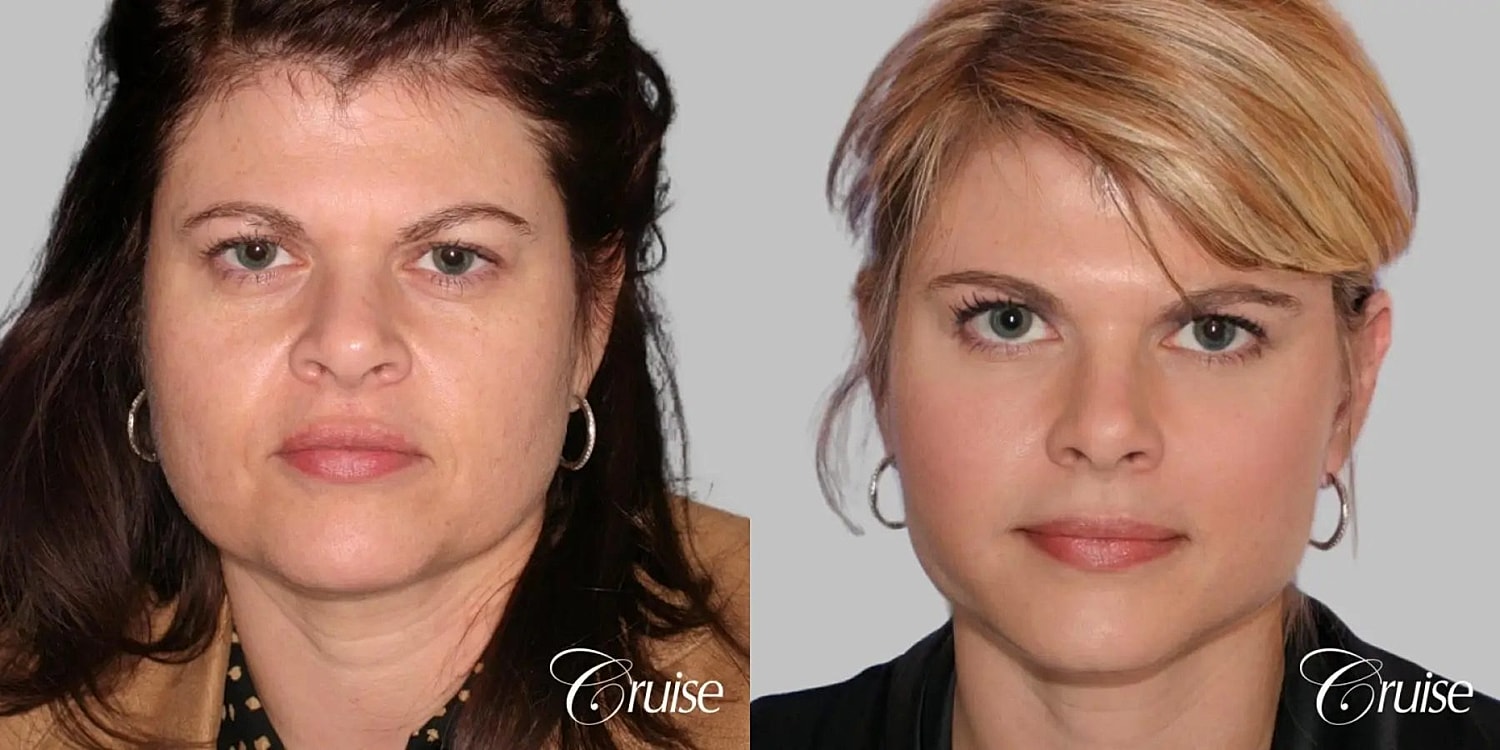 Face Lift Before & After