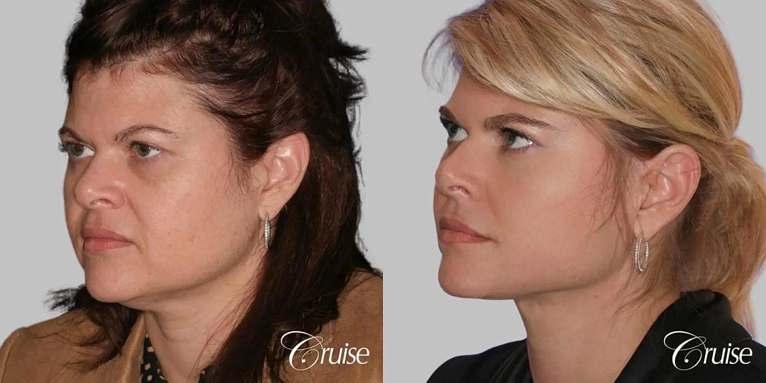 Face Lift Before & After