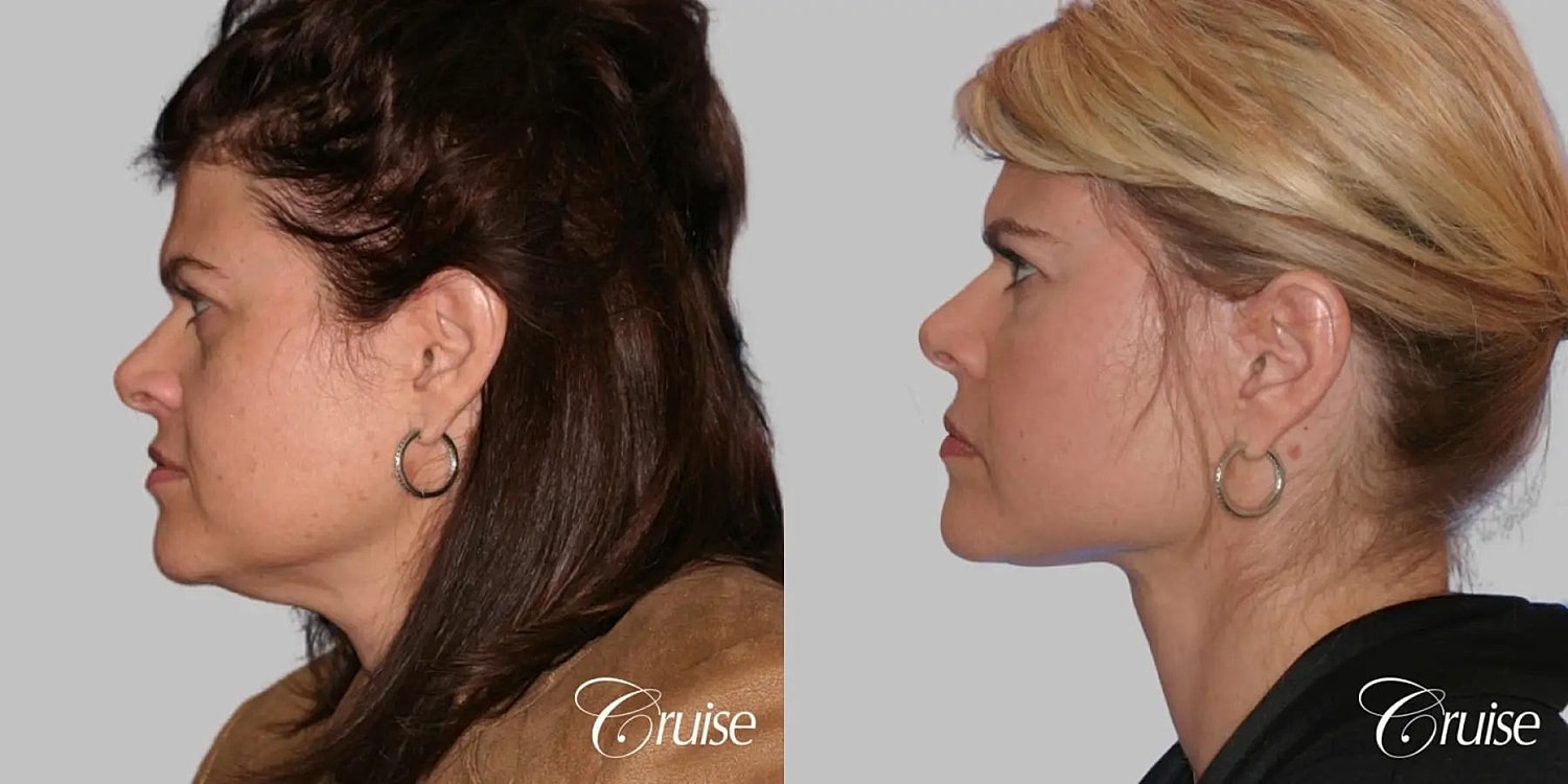 Face Lift Before & After