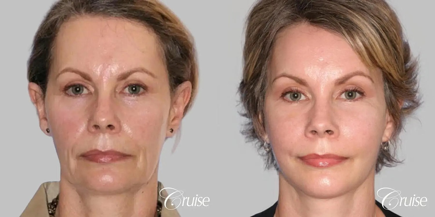 Face Lift Before & After