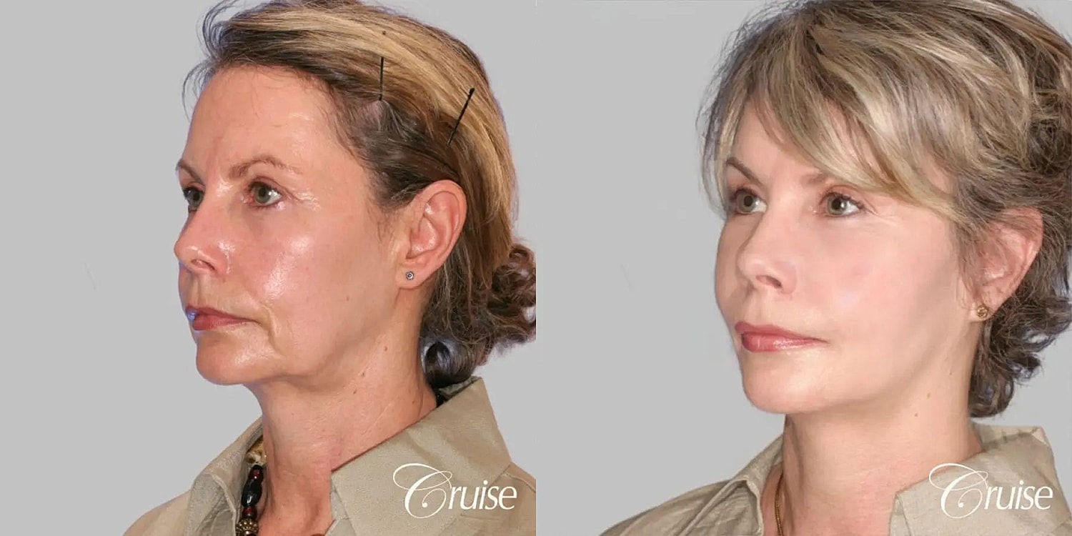 Face Lift Before & After