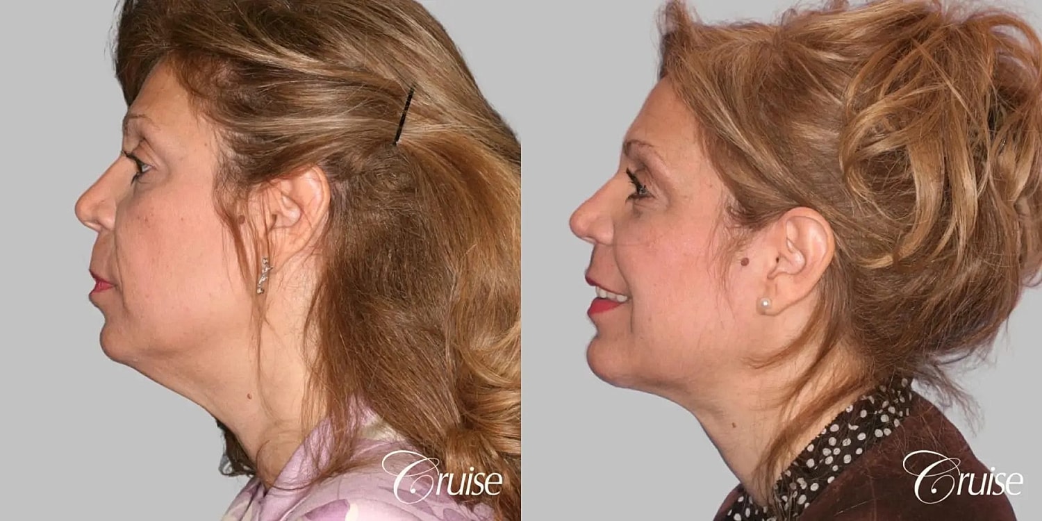 Face Lift Before & After