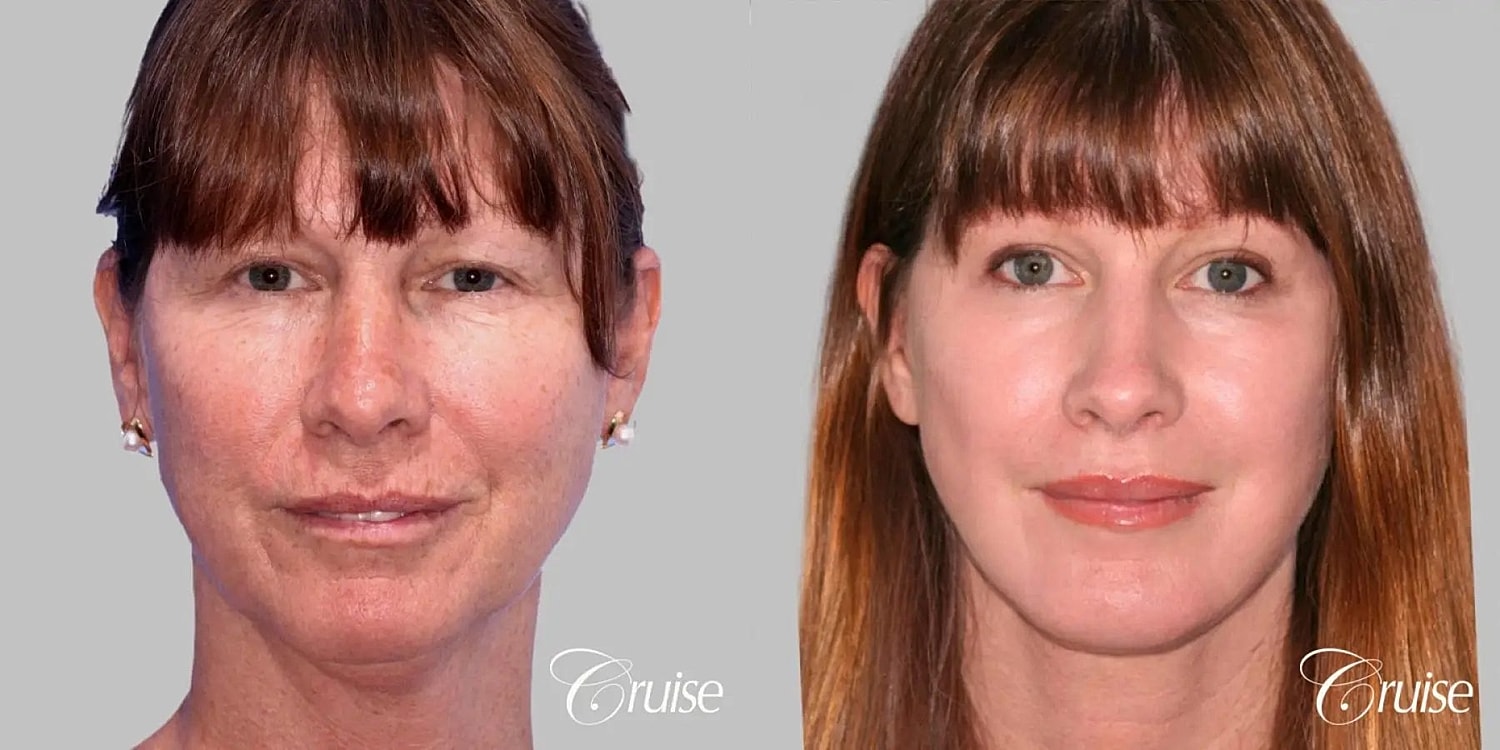 Face Lift Before & After
