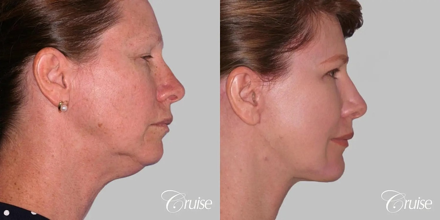 Face Lift Before & After