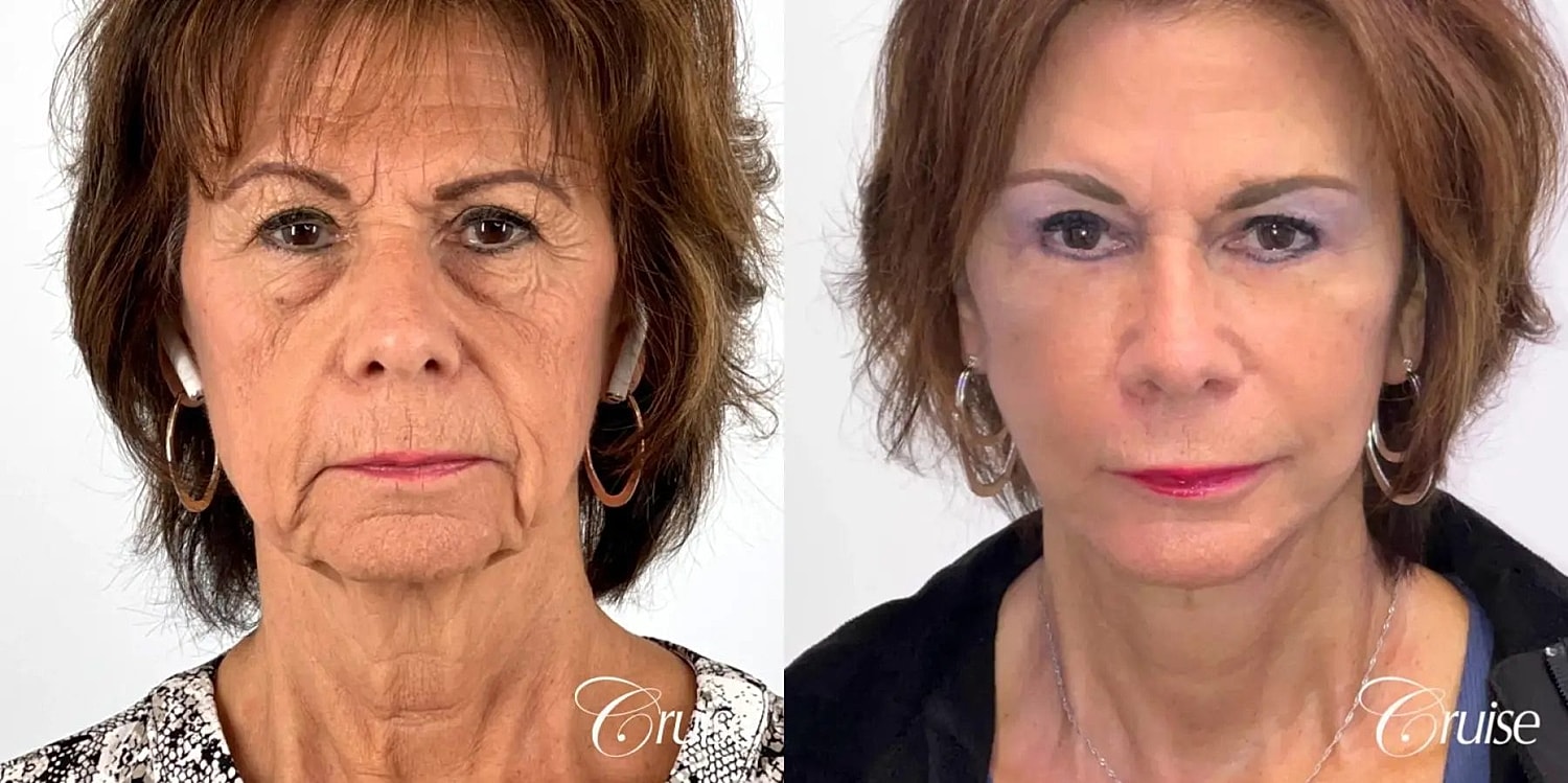 Face Lift Before & After