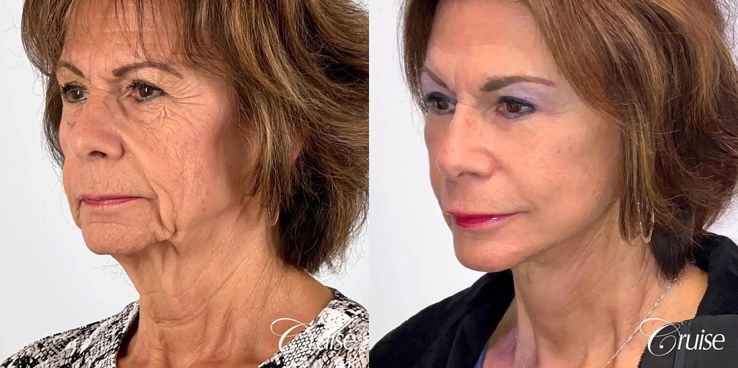 Face Lift Before & After