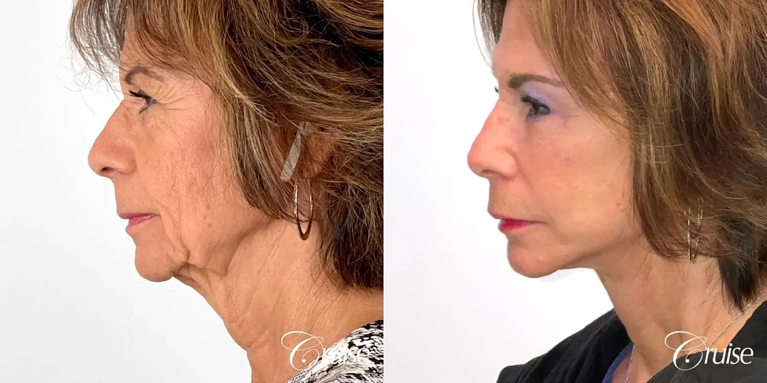 Face Lift Before & After