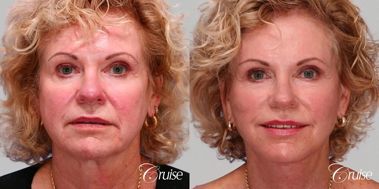 Face Lift Before & After