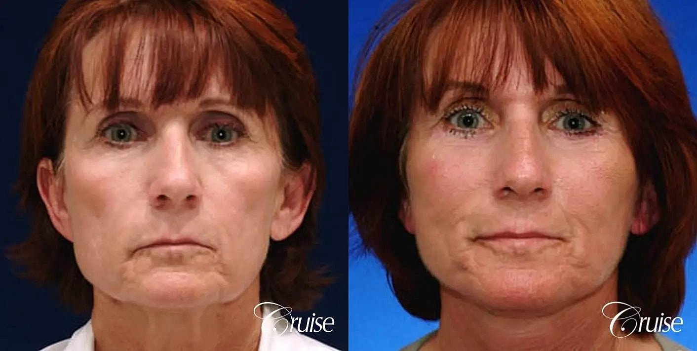 Face Lift Before & After