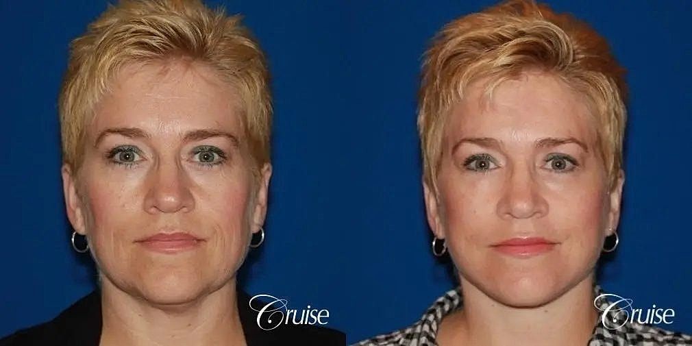 Face Lift Before & After