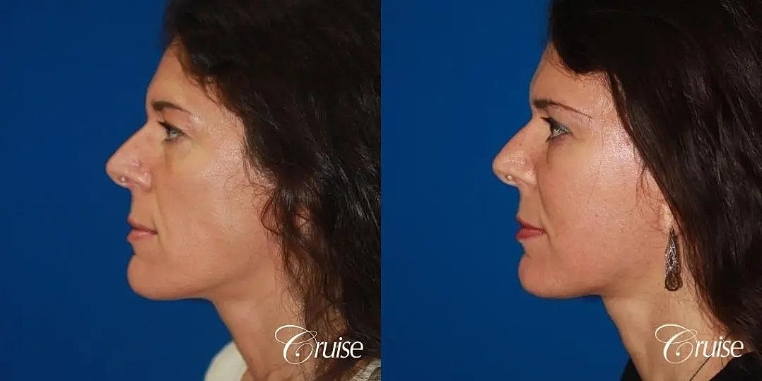 Face Lift Before & After