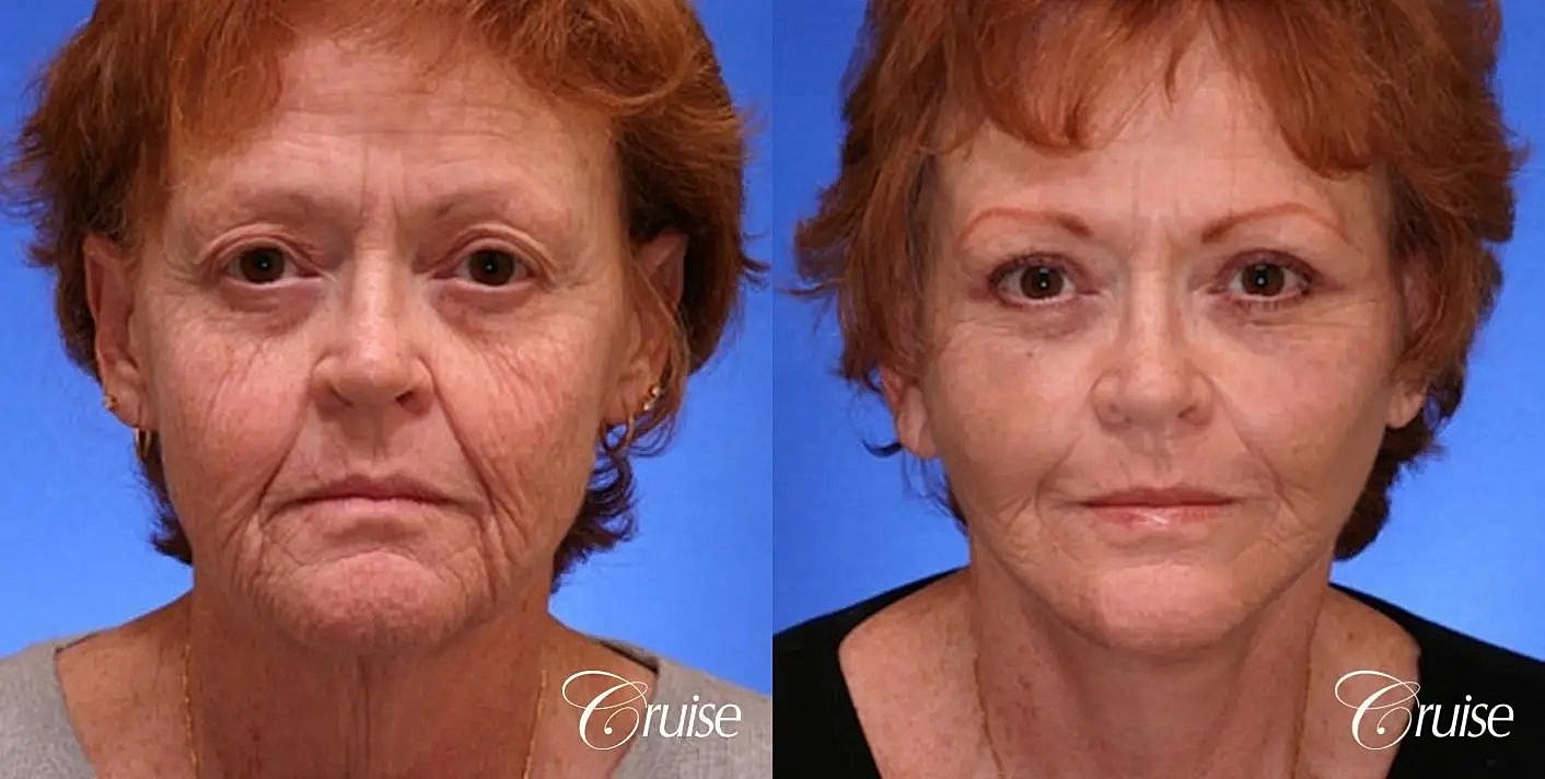Face Lift Before & After
