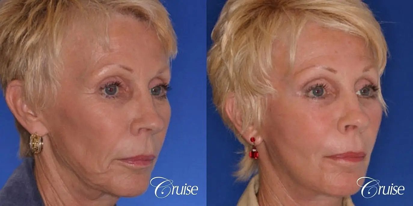 Face Lift Before & After