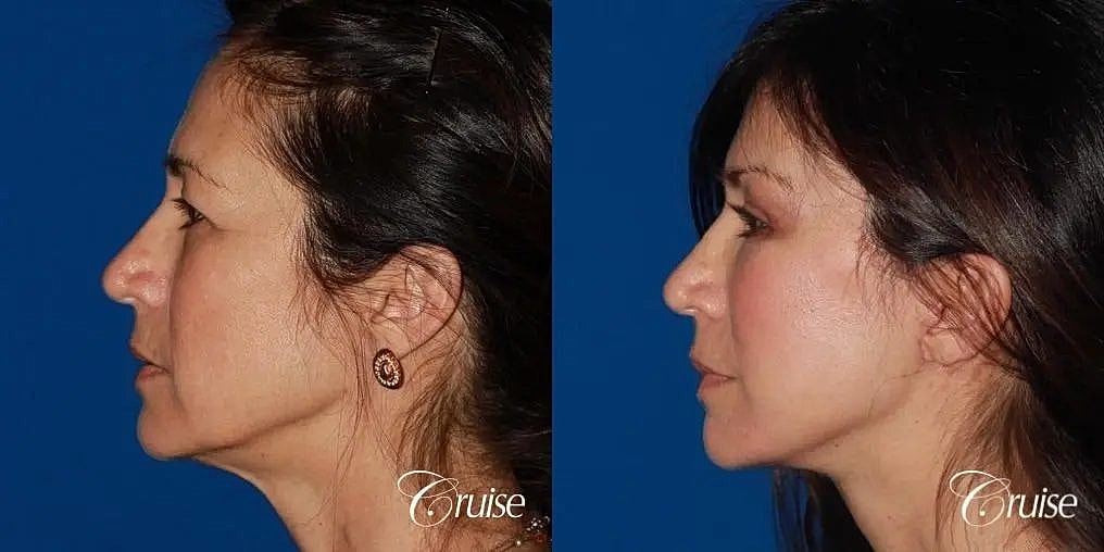 Face Lift Before & After